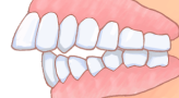 イラスト図：出っ歯のイラスト